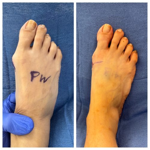 Bunion BNA 1