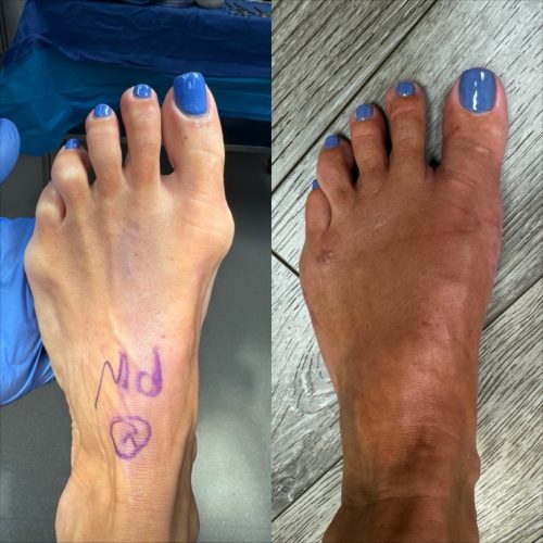 Bunion BNA 10