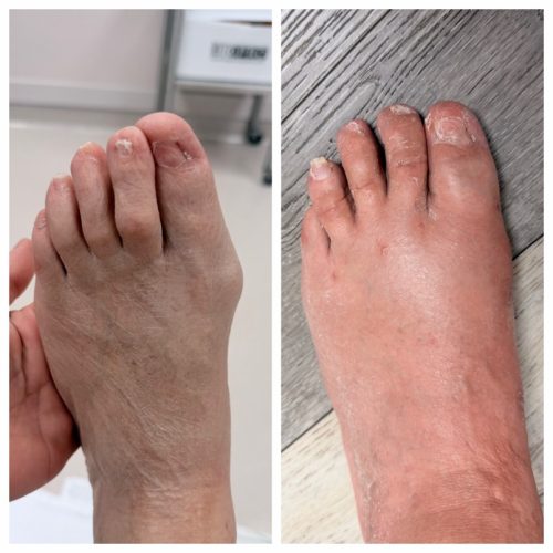 Bunion BNA 12