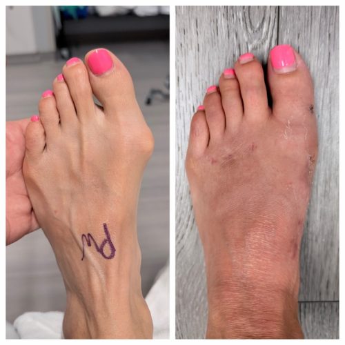 Bunion BNA 13