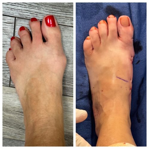 Bunion BNA 15