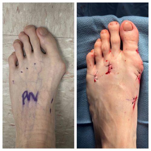 Bunion BNA 16