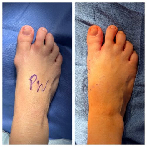 Bunion BNA 18