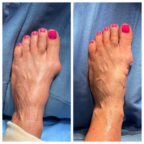 Bunion BNA 19