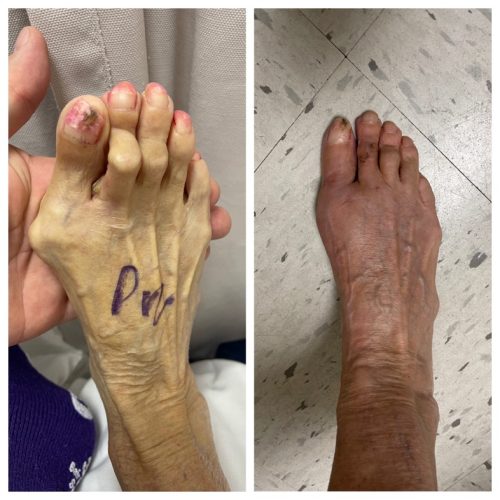 Bunion BNA 2