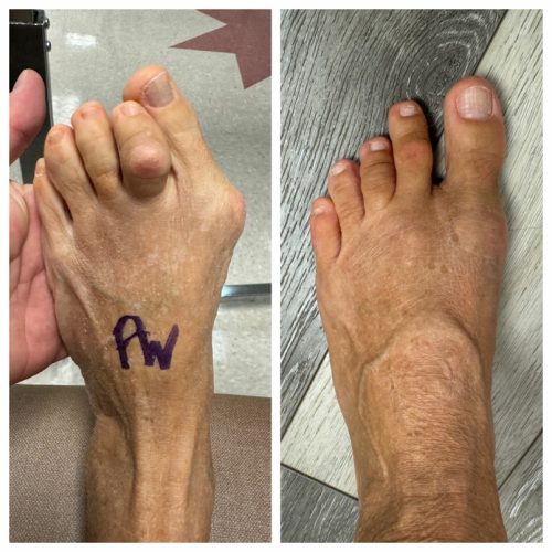 Bunion BNA 20