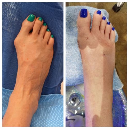 Bunion BNA 21
