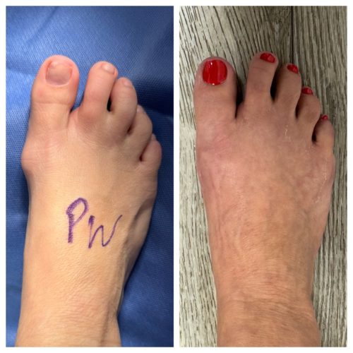 Bunion BNA 4