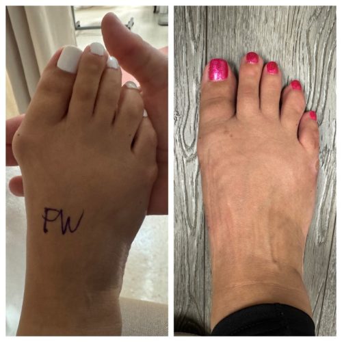 Bunion BNA 5