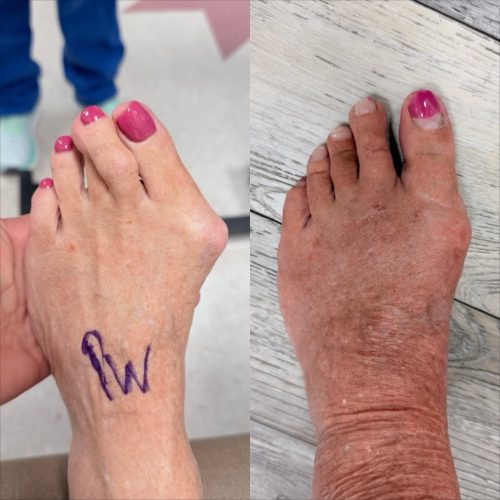 Bunion BNA 6