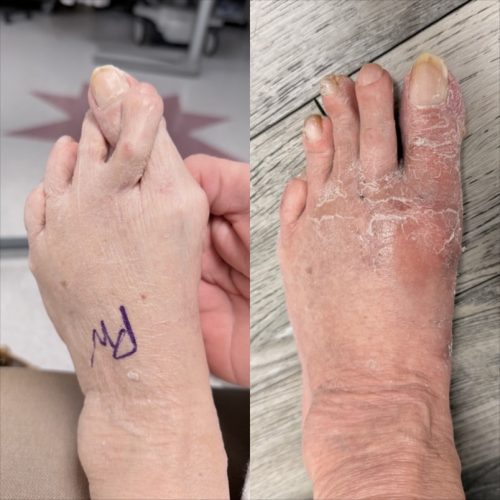 Bunion BNA 7