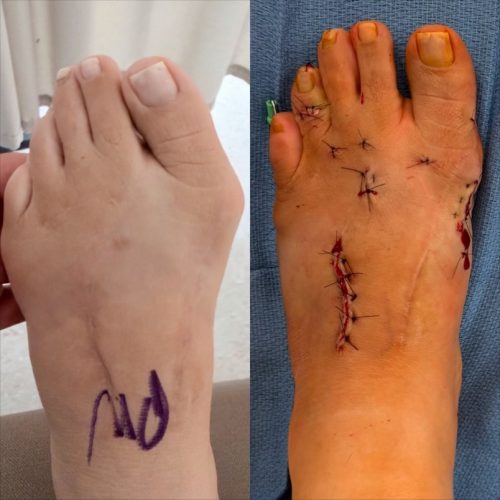 Bunion BNA 8