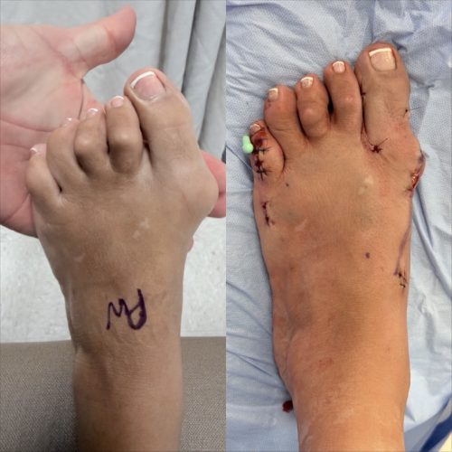 Bunion BNA 9