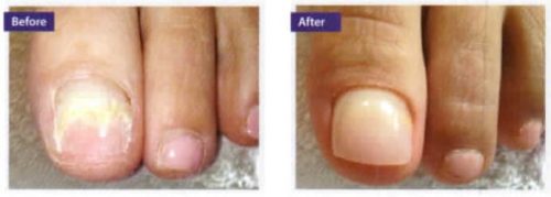 damage_nails_1