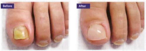 damage_nails_3